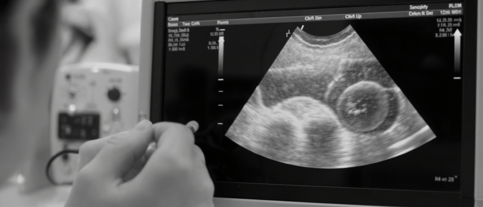 découvrez les causes, symptômes et traitements du bec-de-lièvre et de la fente palatine chez les bébés. informez-vous sur la prise en charge médicale et l'accompagnement des familles concernées.